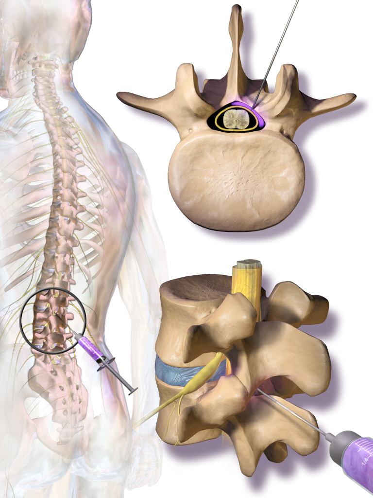 Medical illustration of a lumbar epidural steroid injection — needle entering the epidural space behind the spinal cord with three views: posterior view of the back showing injection level, axial cross-section of vertebra showing needle in epidural space, and lateral view of vertebra with needle path.