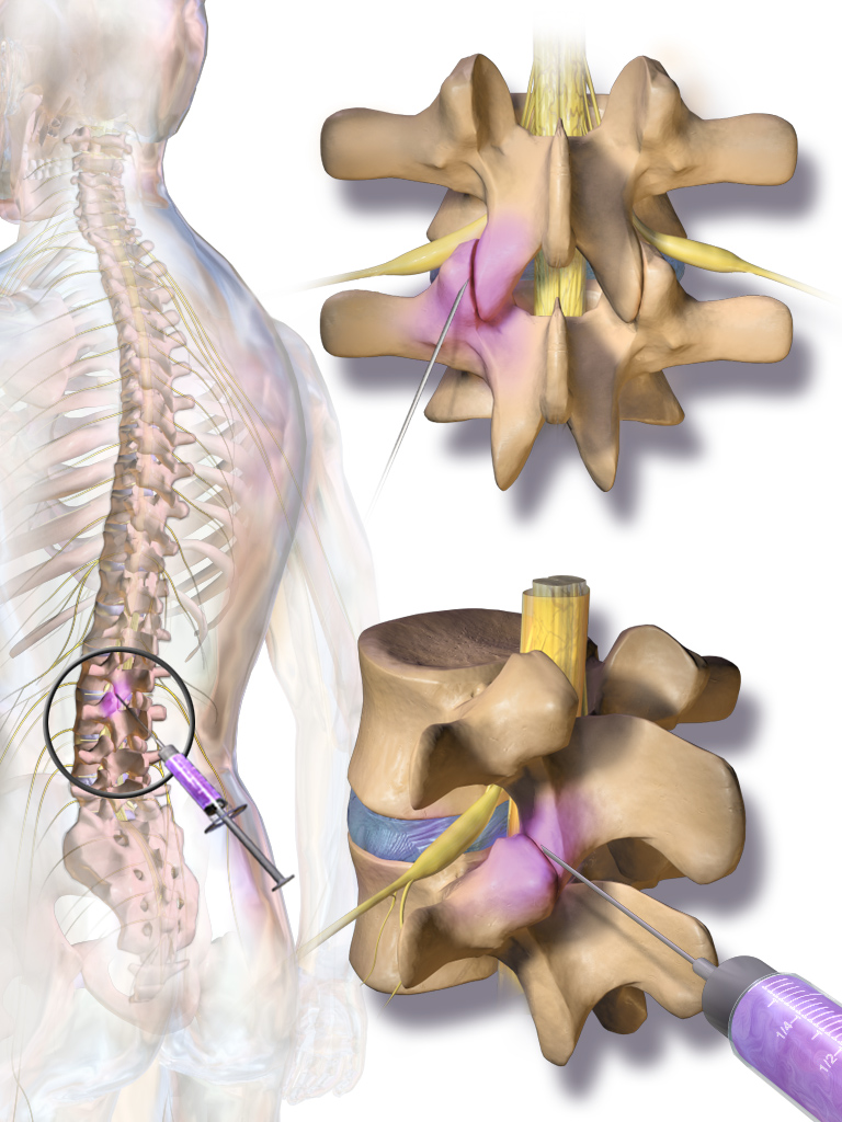 Medical illustration of a facet joint injection — three views showing the back, posterior view of lumbar vertebrae with needles entering the facet joints, and a 3/4 perspective of vertebrae with the facet joint highlighted.