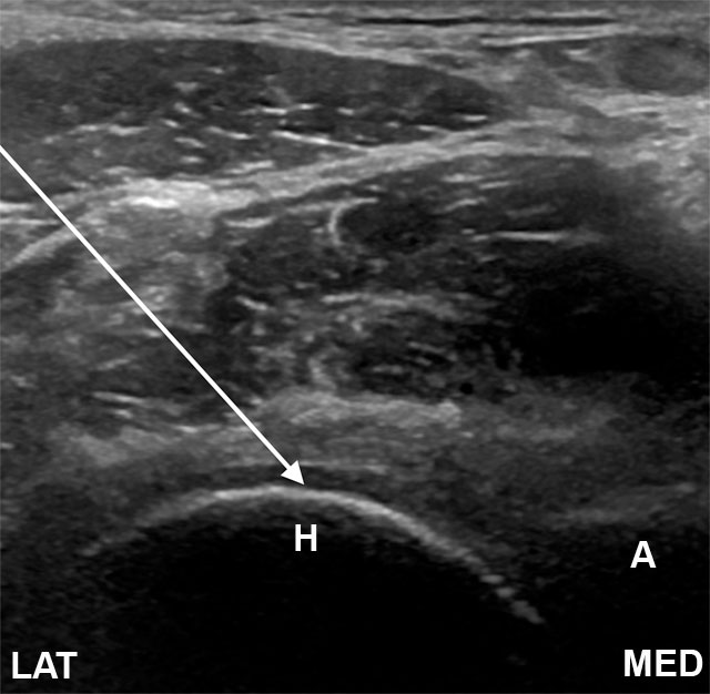 Ultrasound image of a needle entering a joint capsule.