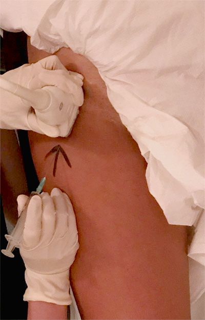 Photograph of an ultrasound-guided hip joint injection in progress — gloved hands hold an ultrasound transducer above and a syringe approaching the joint from below, with the injection landmarks marked on the skin.